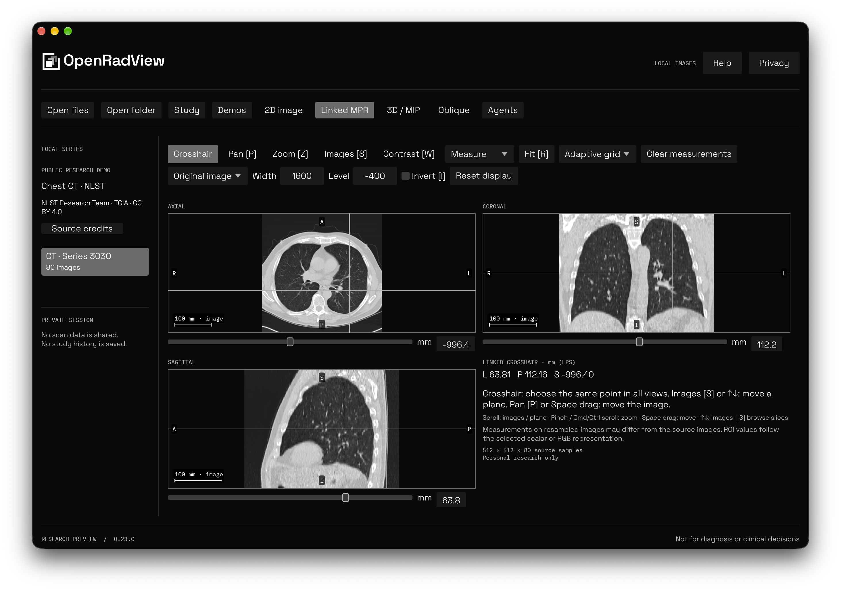 OpenRadView displaying linked axial, coronal and sagittal Multi-Planar Reconstruction views of the included public NLST chest CT